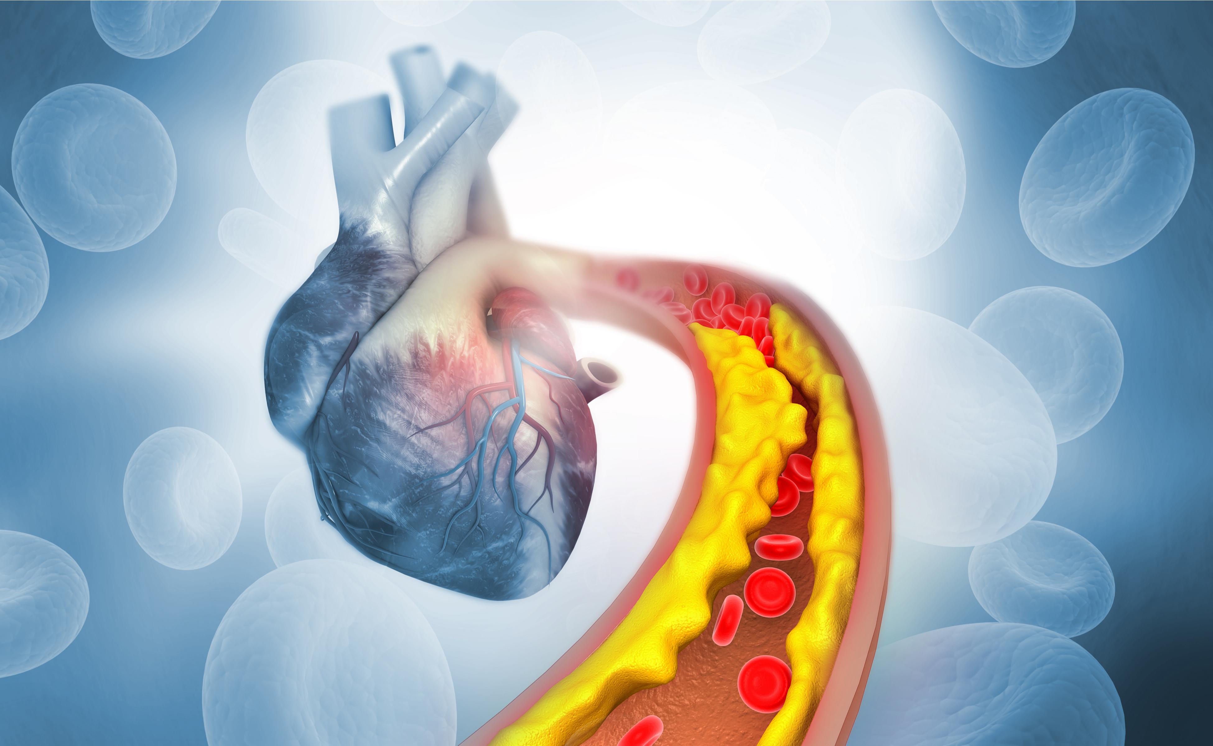 High Cholesterol What It Means What Causes It And How To Reduce Your 