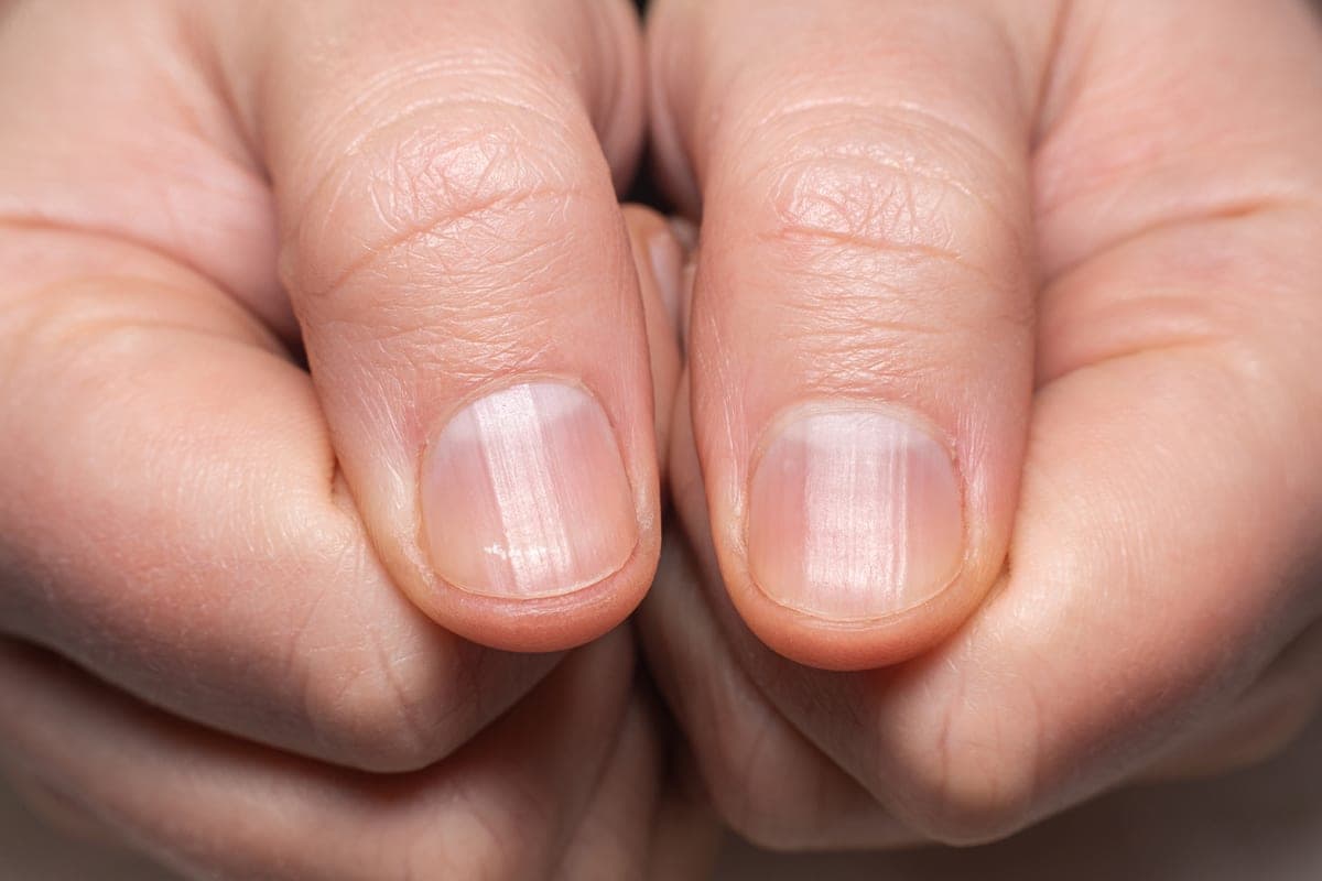 White lines on fingernails